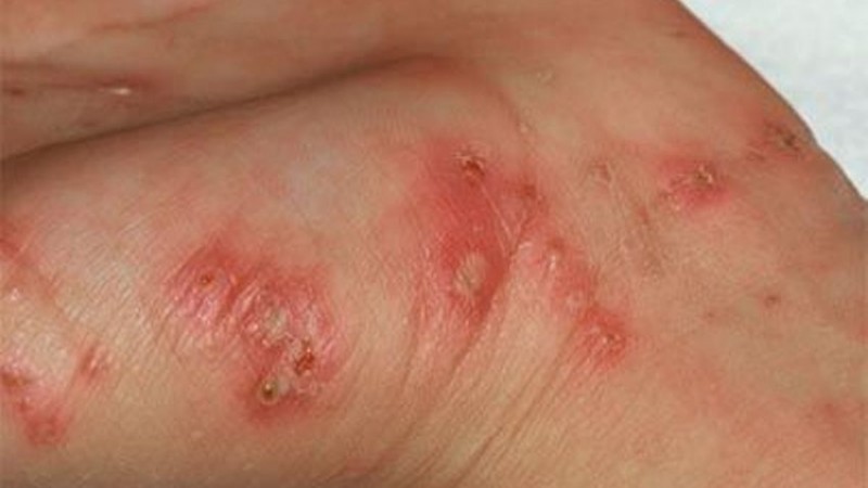 typhus_disease